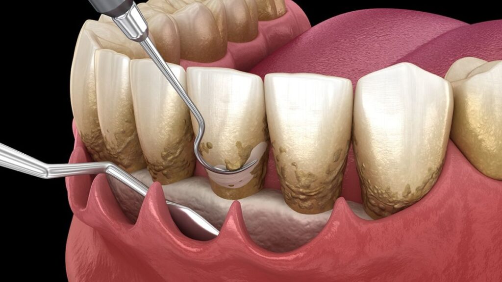 Periodontal Disease