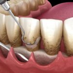 Gum Health, Whole Health: How Periodontal Disease Treatment Upgrades Your Life