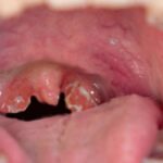 Adenoidid vs. Tonsils: What’s the Difference and Why It Matters